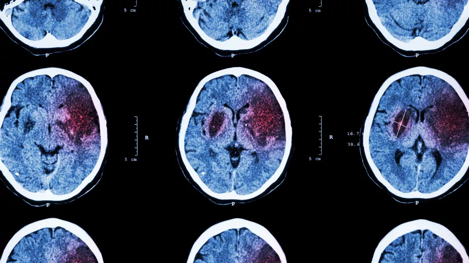 röntgenbild på hjärna som drabbats av stroke. foto.