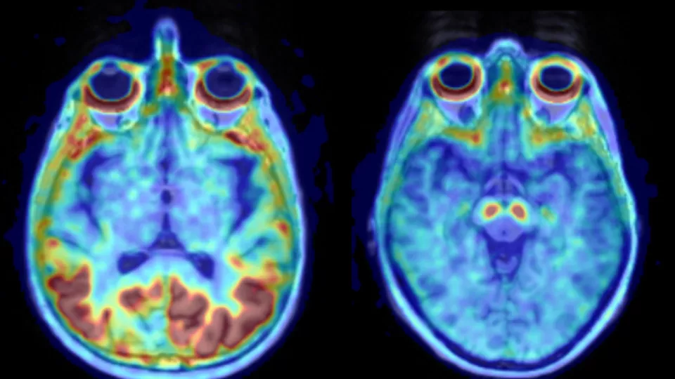 I en klinisk studie har forskare funnit att det sjukdomsalstrande proteinet tau ansamlas fortare hos kvinnor än hos män. Till vänster visas patologiskt upptag av hur proteinet tau i hjärnan (rött). Till höger frisk hjärna. Bild.