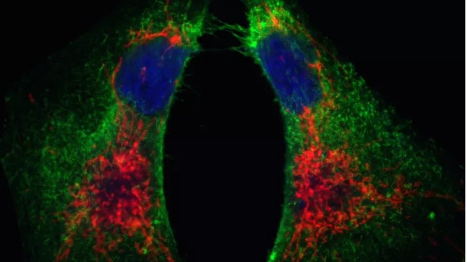 Bild tagen i mikroskop föreställande bröstcancerceller som uttrycker en stamcellsmarkör (i grönt) och ett tätt sammanvuxet mitokondrielt nätverk ( i rött). Foto.