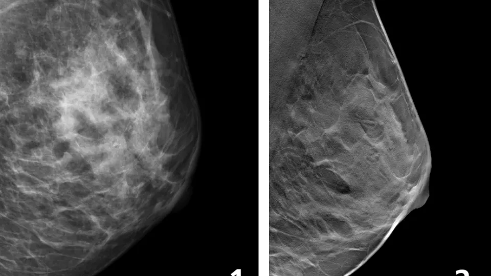 Två röntgenbilder. Den första från mammografi som gjorts med en speciell röntgenapparat där strålningsmängden är liten. Den andra gjord med brösttomosyntes som är en typ av 3D-mammografi som ger en mer detaljerad bild av bröstet än vanlig mammografi. Foto.