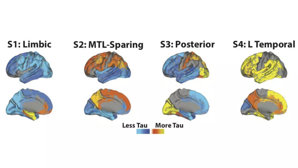 Ett internationellt team av forskare visar att spridningen av proteinet tau i hjärnan vid alzheimer varierar enligt fyra distinkta mönster. Läs mer i artikeln. Bildkälla: Jacob Vogel. 