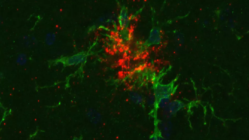 Hjärnans mikrogliaceller (grönt) har förmågan att plocka upp klumpar av beta-amyloid (rött) som ansamlas vid Alzheimers sjukdom. ECT verkar inte försämra denna process, visar forskare i ny studie. Bildkälla: Forskargruppen experimentell neuroinflammation. 