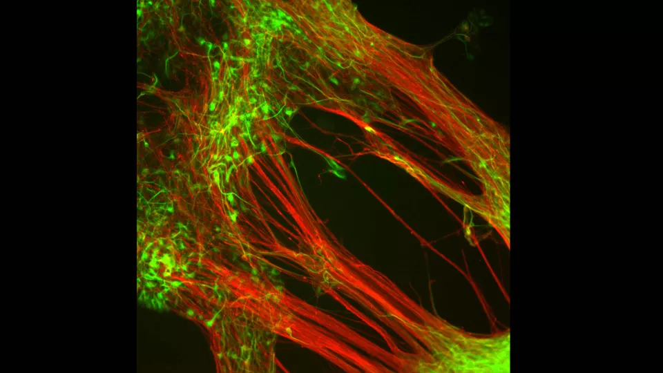  Dopaminproducerande nervceller som forskare från Lunds universitet odlat fram i laboratorium från humana embryonala stamceller. Foto: Agneta Kirkeby. 