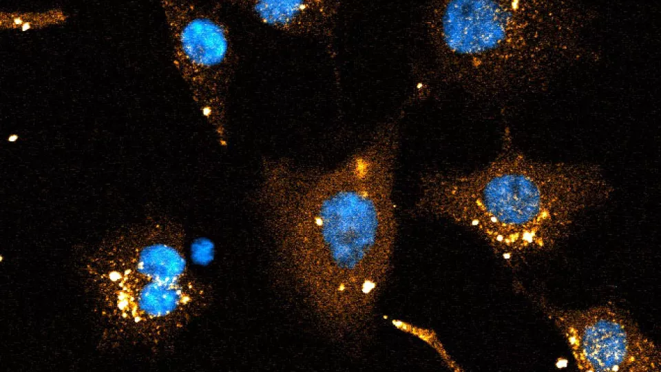 Bild på dubbelsträngade RNA-molekyler, siRNA, som levererats till livmoderhalscancer-celler (cellkärnorna visas i blått). Den diffusa orangea signalen runt kärnan är från RNA som nått det inre av cellen, cytosolen. 