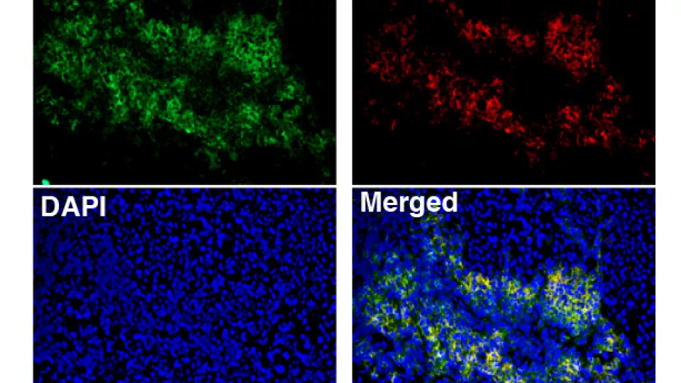 bild på Immunofluoroscence-analys av en melanomtumör som visar att B-celler i B-cellskluster uttrycker CXCR5, som är en markör för tertiära lymfoida strukturer. Källa: Göran Jönsson