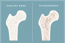 illustration av ben med osteoporos. foto.