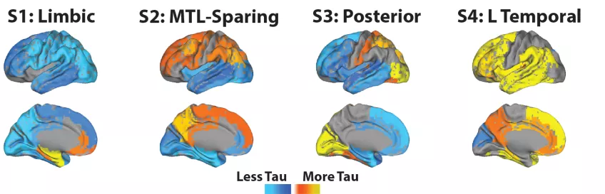 Ett internationellt team av forskare visar att spridningen av proteinet tau i hjärnan vid alzheimer varierar enligt fyra distinkta mönster. Läs mer i artikeln. Bildkälla: Jacob Vogel. 