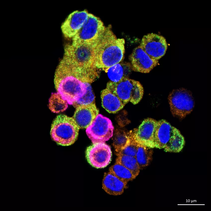 Mikroskopibild av isolerade Langerhanska öar, där betacellerna som producerar insulin finns. Det orangea i bilden är proteinvarianten IRIS-2, det gröna insulin och det blå är cellkärnor. Foto.