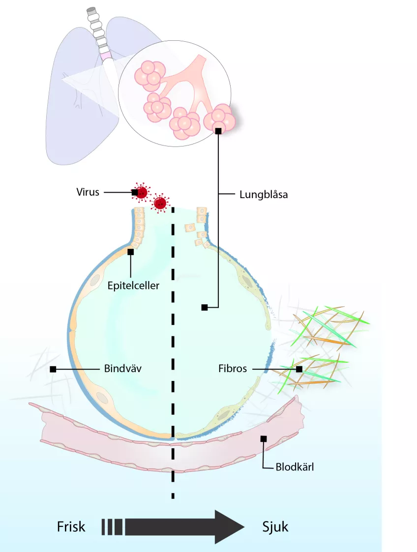 En schematisk bild av en lunga som visar hur de förändras som följd av covid-19 infektion.
