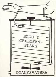 Principskiss av enkel dialysapparat. Illustration.
