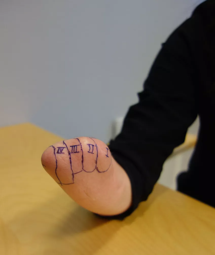 PHM är en känselkarta på underarmen (eller i ansiktet) där nervimpulser på huden väcker en fantomkänsla i hjärnan av beröring på den förlorade handen. Känselkartan kan se olika ut hos olika personer, det finns ofta en punkt för varje finger. Foto: U. Wijk