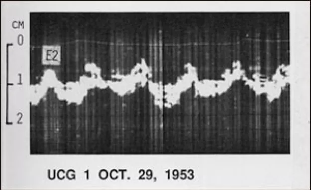 Det första ultraljudskardiogrammet.
